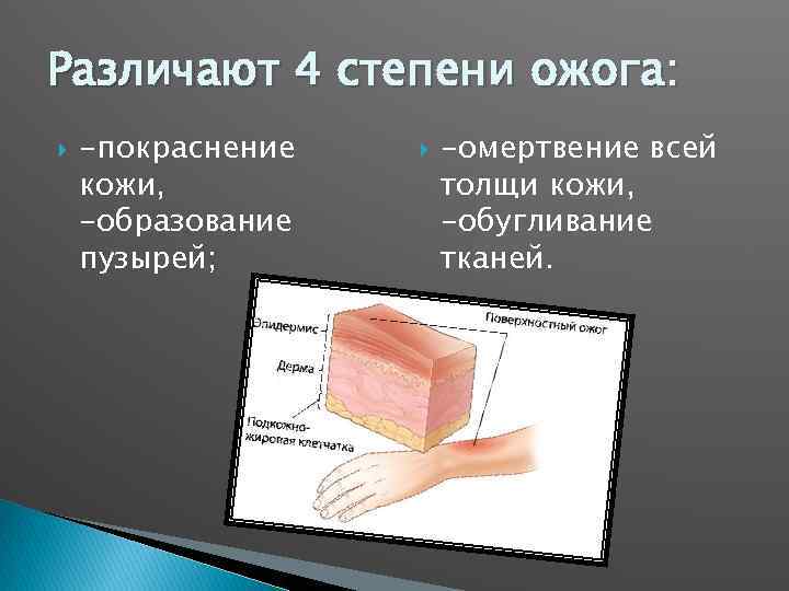 Различают 4 степени ожога: -покраснение кожи, -образование пузырей; -омертвение всей толщи кожи, -обугливание тканей.