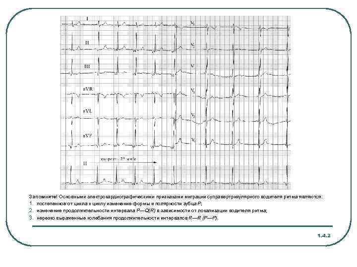 Запомните! Основными электрокардиографическими признаками миграции суправертрикулярного водителя ритма являются: 1. постепенное от цикла к