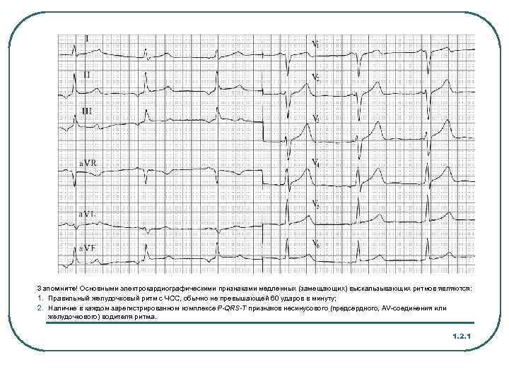 Запомните! Основными электрокардиографическими признаками медленных (замещающих) выскальзывающих ритмов являются: 1. Правильный желудочковый ритм с