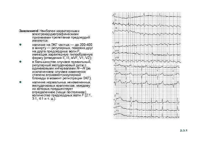 Запомните! Наиболее характерными электрокардиографическими признаками трепетания предсердий являются: l наличие на ЭКГ частых —