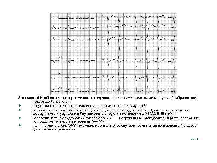 Запомните! Наиболее характерными электрокардиографическими признаками мерцания (фибрилляции) предсердий являются: l отсутствие во всех электрокардиографических