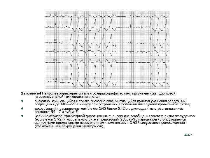 Запомните! Наиболее характерными электрокардиографическими признаками желудочковой пароксизмальной тахикардии являются: l внезапно начинающийся и так