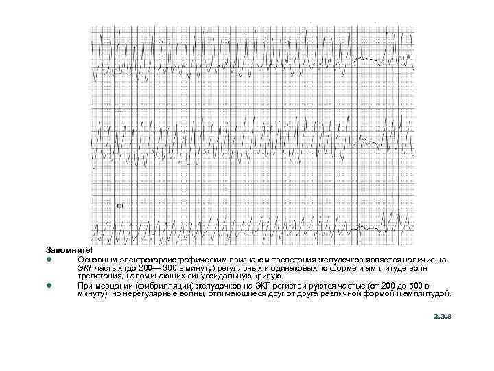 Запомните! l Основным электрокардиографическим признаком трепетания желудочков является наличие на ЭКГ частых (до 200—