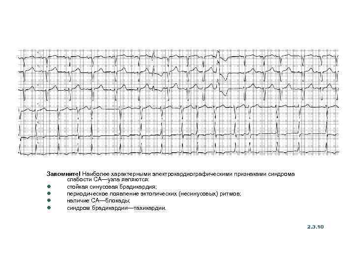 Запомните! Наиболее характерными электрокардиографическими признаками синдрома слабости СА—узла являются: l стойкая синусовая брадикардия; l