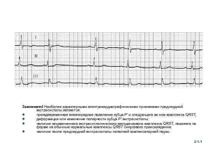 Запомните! Наиболее характерными электрокардиографическими признаками предсердной экстрасистолы являются: l преждевременное внеочередное появление зубца Р'