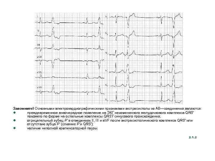 Запомните! Основными электрокардиографическими признаками экстрасистолы из АВ—соединения являются: l преждевременное внеочередное появление на ЭКГ