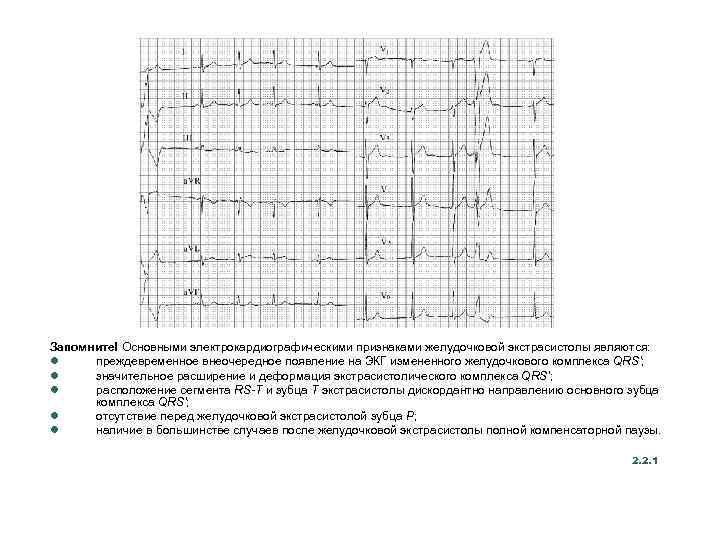 Запомните! Основными электрокардиографическими признаками желудочковой экстрасистолы являются: l преждевременное внеочередное появление на ЭКГ измененного