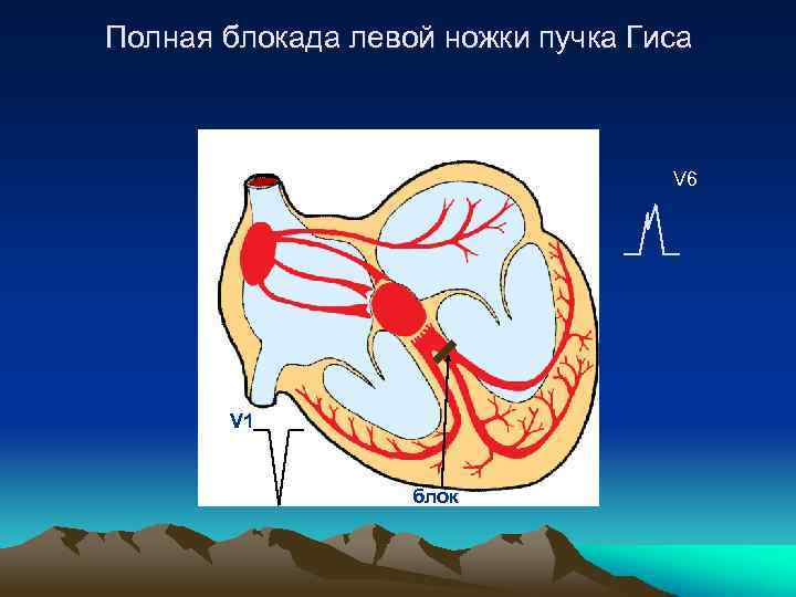 Блокада левого пучка гиса. Блокада левая ножка пучка Гиса. Пучок Гиса в сердце блокада левой ножки. Полная блокада левой ножки пучка Гиса картинки. Схема блокада левой ножки пучка Гиса.