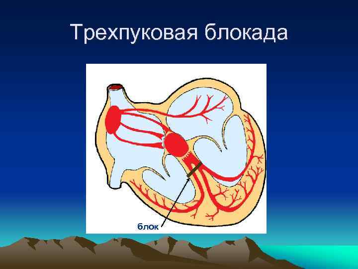 Трехпуковая блокада блок 
