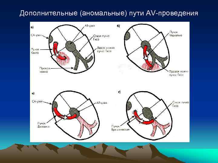 Дополнительные (аномальные) пути AV-проведения 