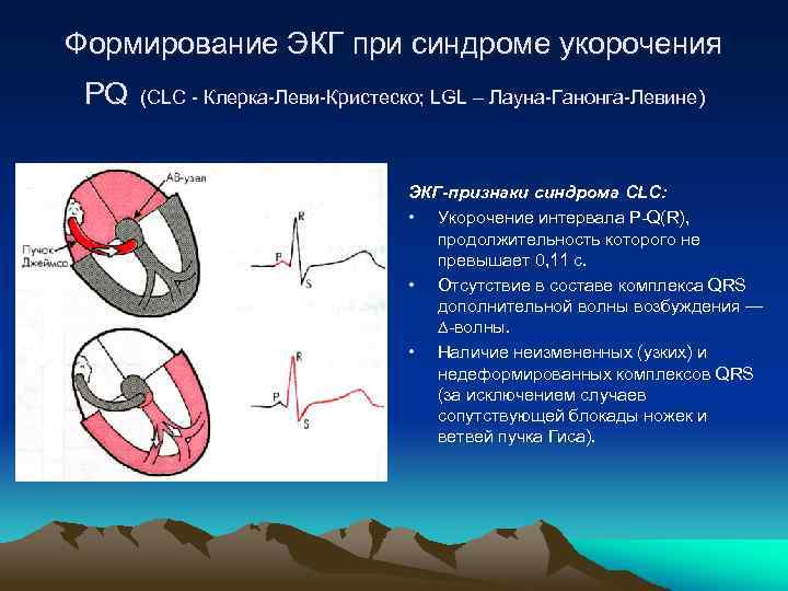 Феномен укороченного pq. ЭКГ при синдроме Клерка Леви. CLC синдром ЭКГ. Синдром CLC (Клерка — Леви — Кристеско). СЛС синдром на ЭКГ.