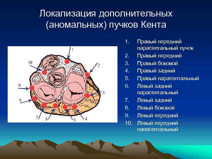 Локализация дополнительных (аномальных) пучков Кента 1. Правый передний парасептальный пучок 2. Правый передний 3.