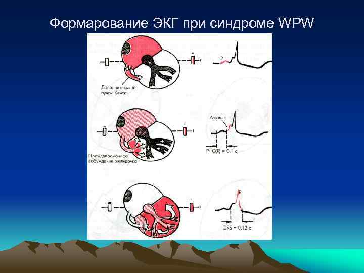 Формарование ЭКГ при синдроме WPW 