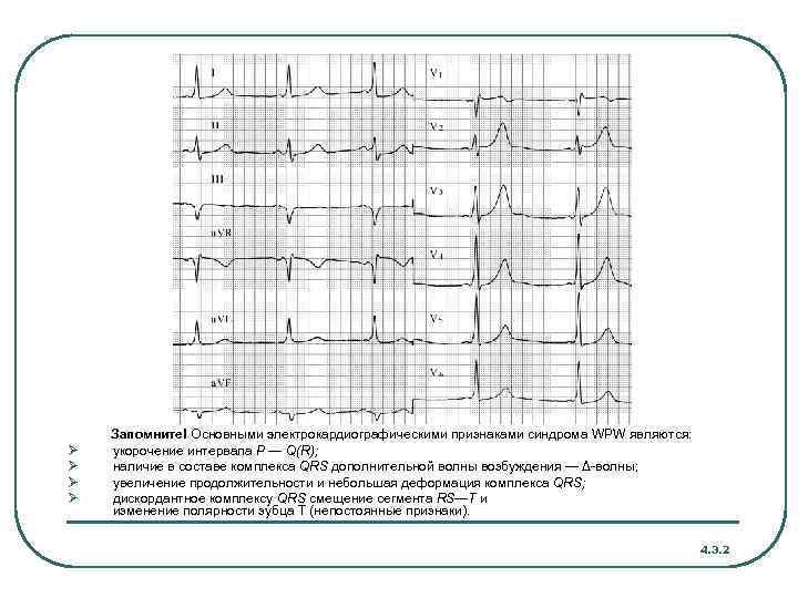 Ø Ø Запомните! Основными электрокардиографическими признаками синдрома WPW являются: укорочение интервала Р — Q(R);