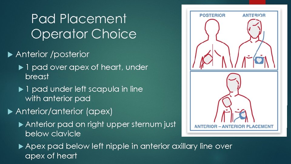 Pad Placement Operator Choice 29 Anterior /posterior 1 pad over apex of heart, under