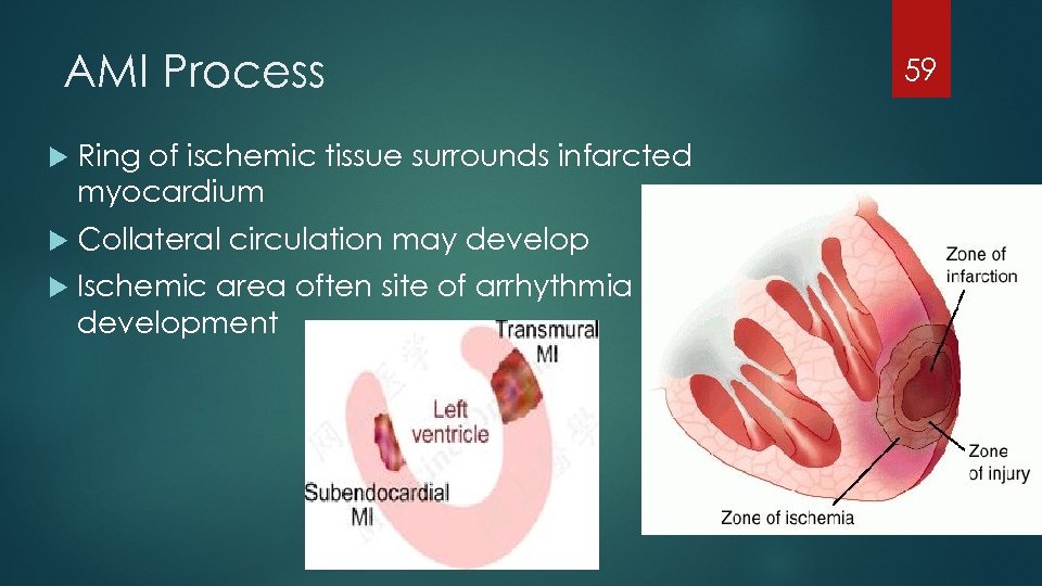 AMI Process Ring of ischemic tissue surrounds infarcted myocardium Collateral circulation may develop Ischemic