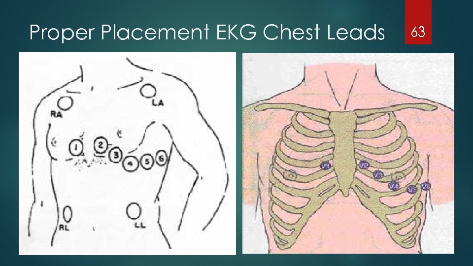 Proper Placement EKG Chest Leads 63 