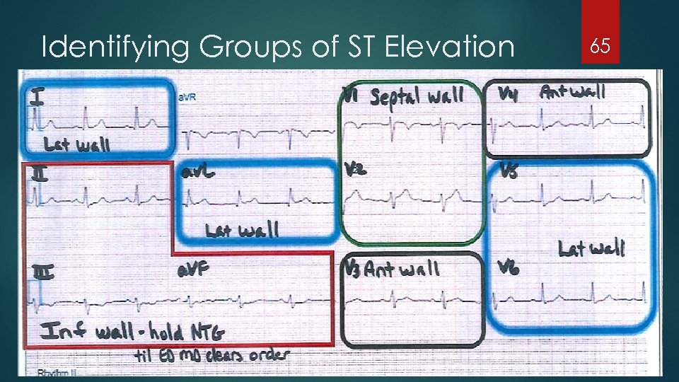 Identifying Groups of ST Elevation 65 