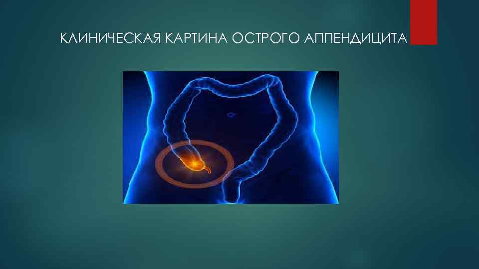 КЛИНИЧЕСКАЯ КАРТИНА ОСТРОГО АППЕНДИЦИТА 