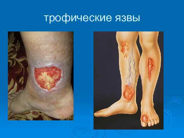 трофические язвы 