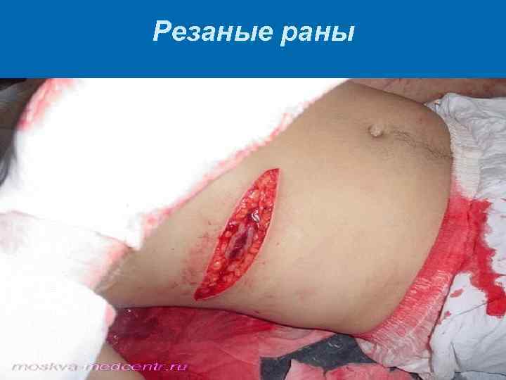 Резаные раны 