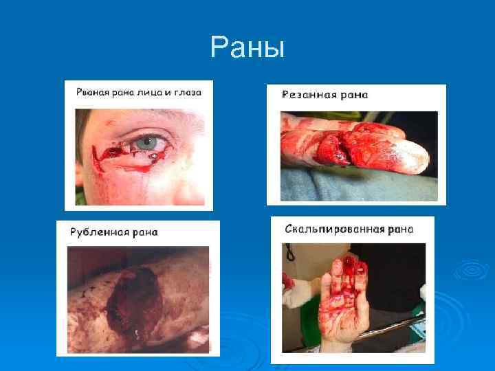 Раны 