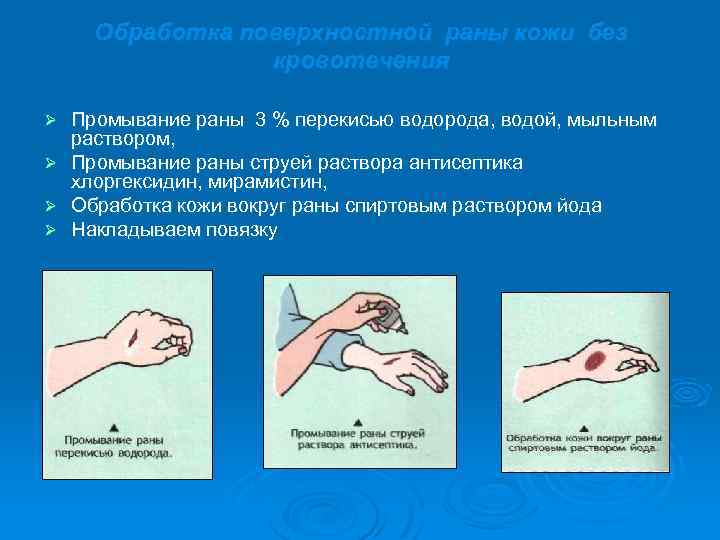 Обработка поверхностной раны кожи без кровотечения Промывание раны 3 % перекисью водорода, водой, мыльным