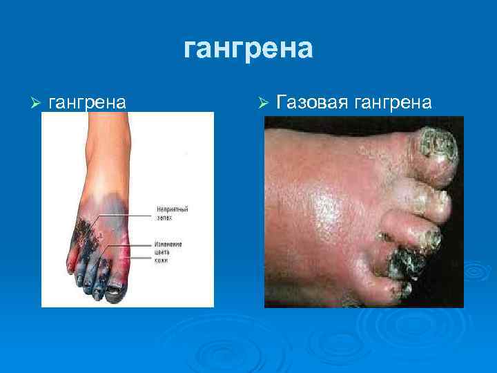 гангрена Ø Газовая гангрена 