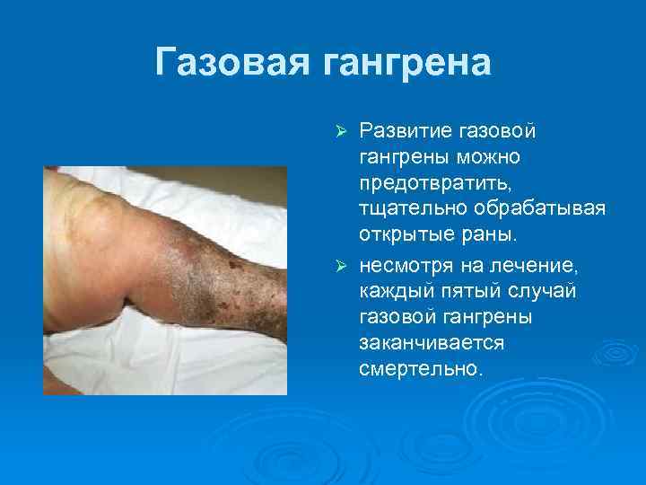 Газовая гангрена Развитие газовой гангрены можно предотвратить, тщательно обрабатывая открытые раны. Ø несмотря на
