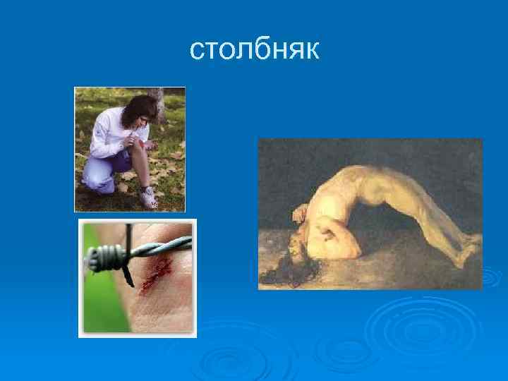столбняк 