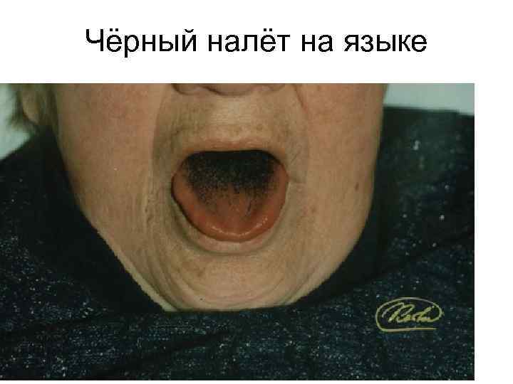 Чёрный налёт на языке 