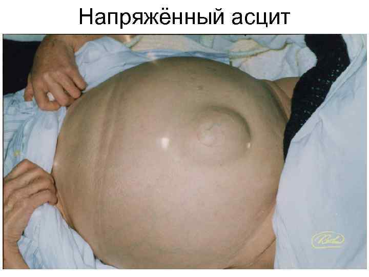 Напряжённый асцит 