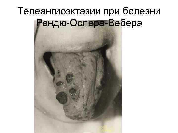 Телеангиоэктазии при болезни Рендю-Ослера-Вебера 