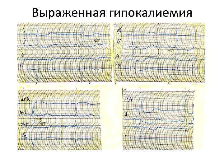 Гипокалиемия на экг картинки