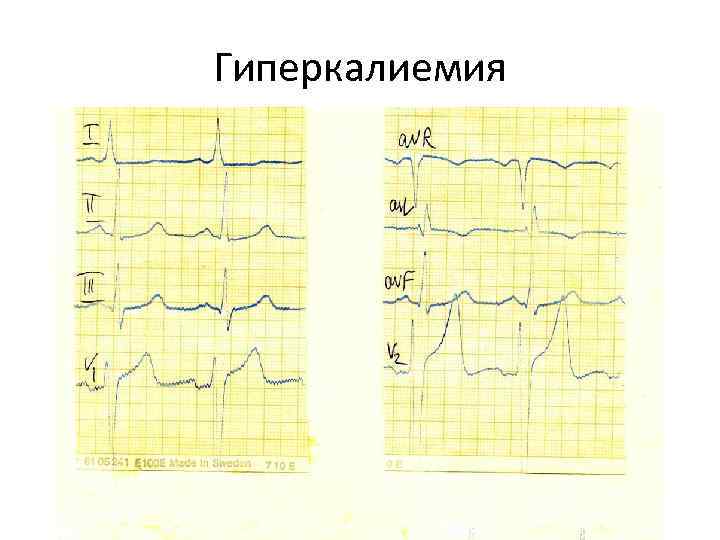 Экг при гиперкалиемии картинки