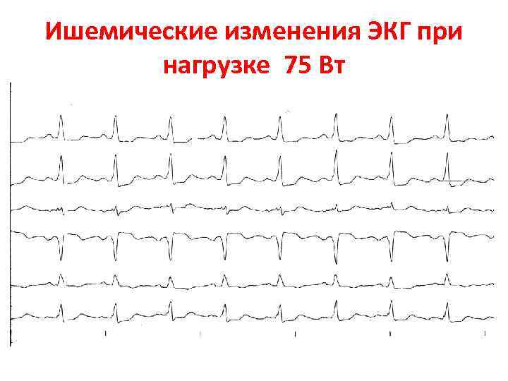 Ишемические изменения ЭКГ при нагрузке 75 Вт 