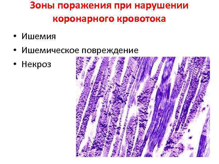 Зоны поражения при нарушении коронарного кровотока • Ишемия • Ишемическое повреждение • Некроз 