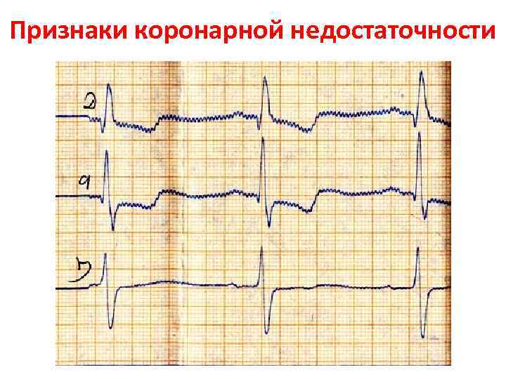 Признаки коронарной недостаточности 
