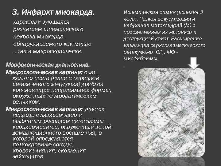 3. Инфаркт миокарда. характери зующаяся развитием шпемического некроза миокарда, обнаруживаемого как микро -, так