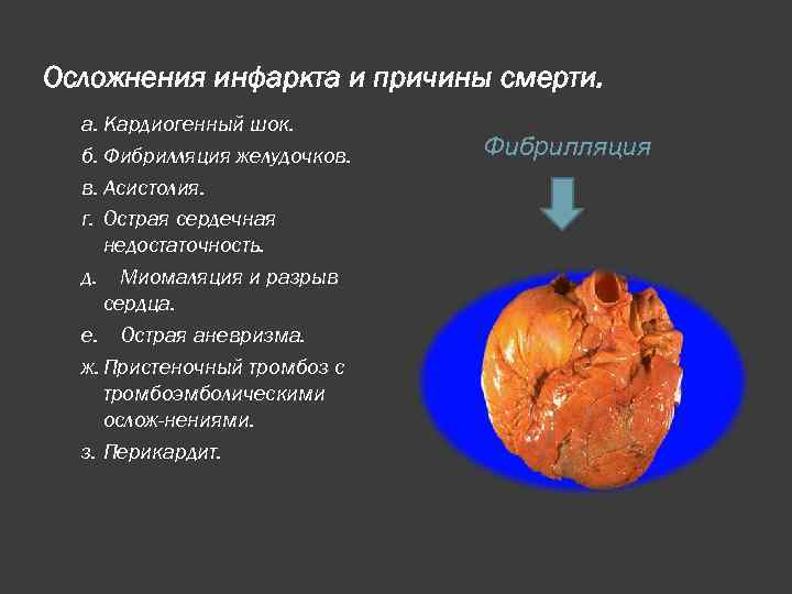 Осложнения инфаркта и причины смерти. а. Кардиогенный шок. б. Фибрилляция желудочков. в. Асистолия. г.