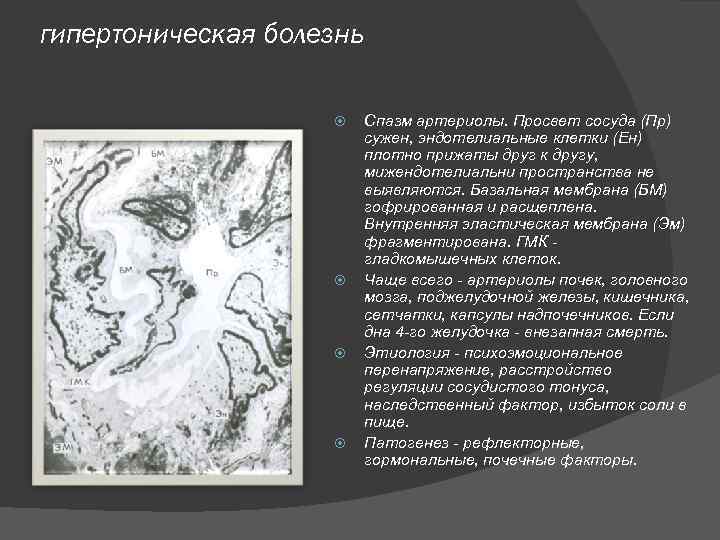 гипертоническая болезнь Спазм артериолы. Просвет сосуда (Пр) сужен, эндотелиальные клетки (Ен) плотно прижаты друг