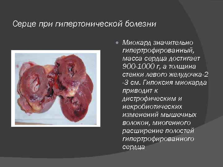 Серце при гипертонической болезни Миокард значительно гипертрофированный, масса сердца достигает 900 -1000 г, а