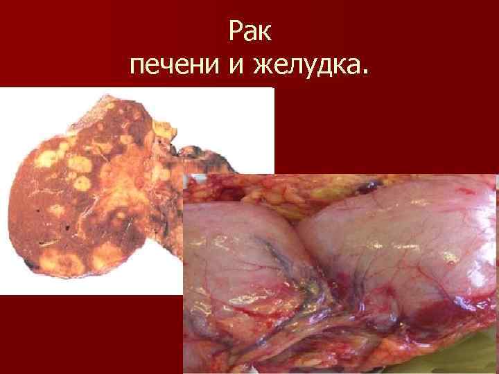 Рак печени и желудка. 