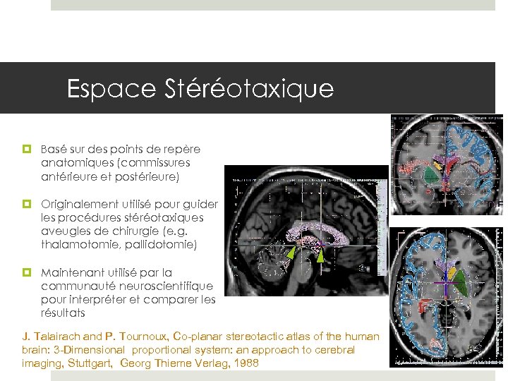 Espace Stéréotaxique Basé sur des points de repère anatomiques (commissures antérieure et postérieure) Originalement