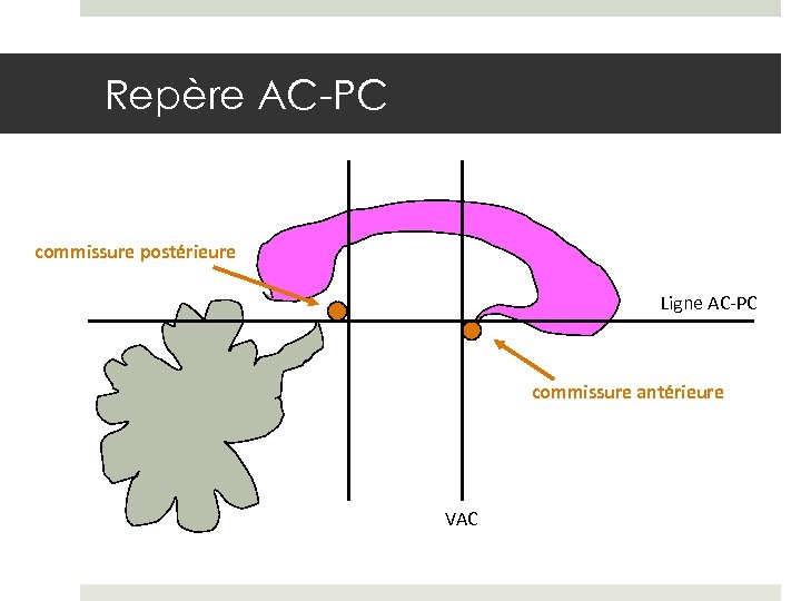 Repère AC-PC commissure postérieure Ligne AC-PC commissure antérieure VAC 