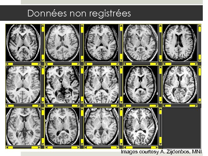 Données non registrées Images courtesy A. Zijdenbos, MNI 