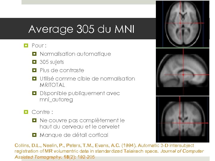 Average 305 du MNI Pour : Normalisation automatique 305 sujets Plus de contraste Utilisé