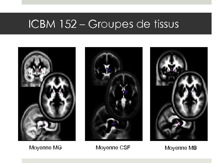 ICBM 152 – Groupes de tissus Moyenne MG Moyenne CSF Moyenne MB 