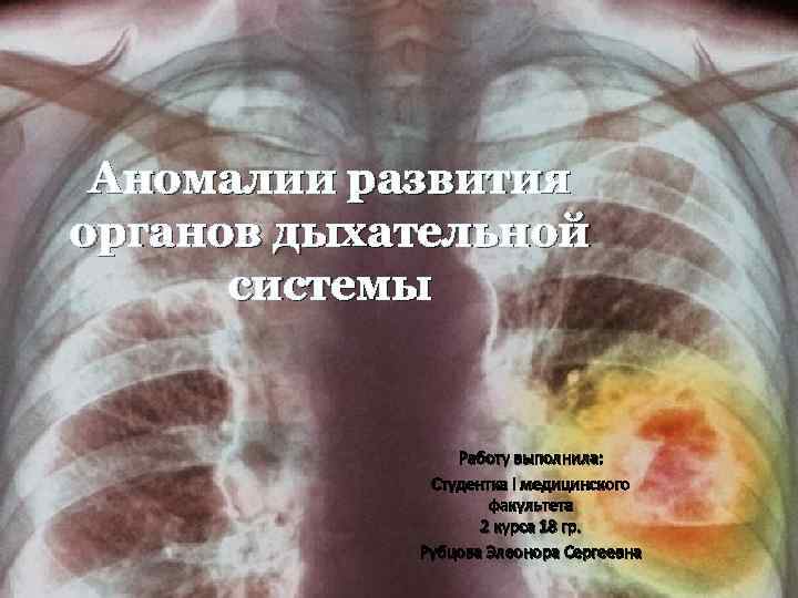 Аномалии развития органов дыхательной системы Работу выполнила: Студентка І медицинского факультета 2 курса 18