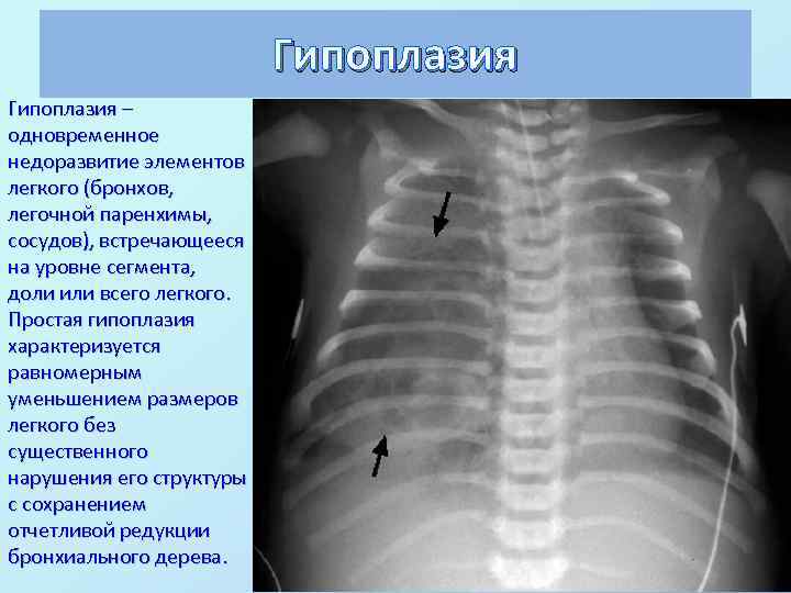 Гипоплазия – одновременное недоразвитие элементов легкого (бронхов, легочной паренхимы, сосудов), встречающееся на уровне сегмента,